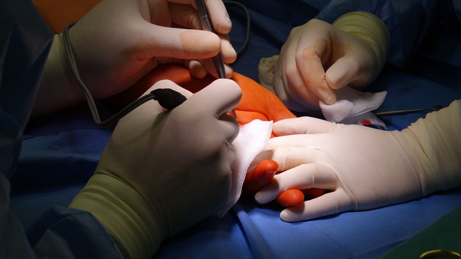 Body Hair Transplant