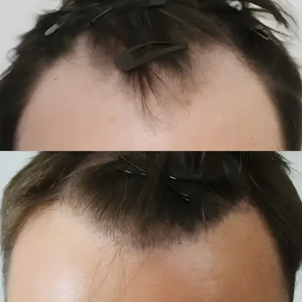 FUE hairline & frontal third — 2,019 grafts / 4,681 hairs