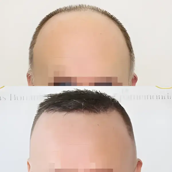 FUE hairline transplant — 2,000 grafts / 4,874 hairs