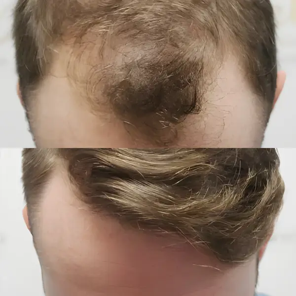 FUE hairline & crown restoration — Dr Bonaros