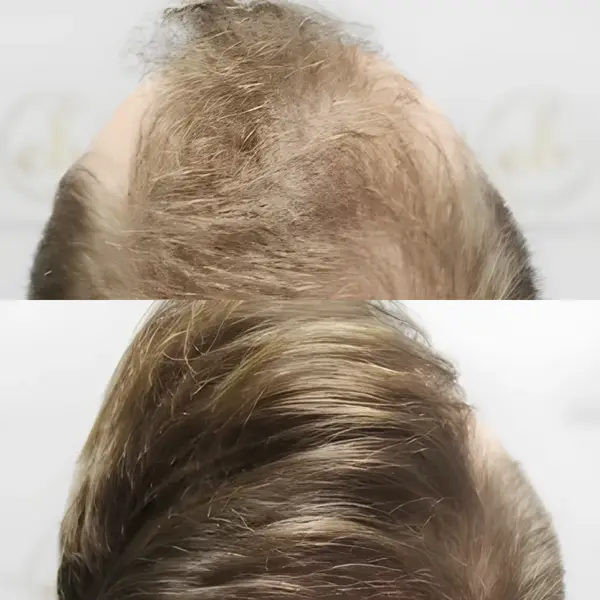 FUE crown & mid-scalp restoration — Dr Bonaros