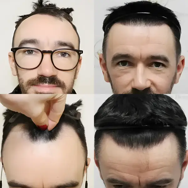 FUE receding hairline — 1,816 grafts / 4,033 hairs