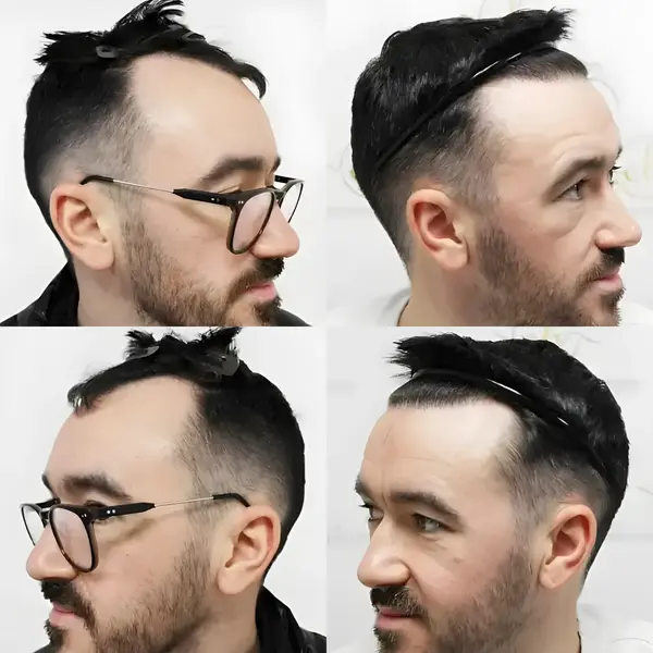 FUE receding hairline — 1,816 grafts / 4,033 hairs