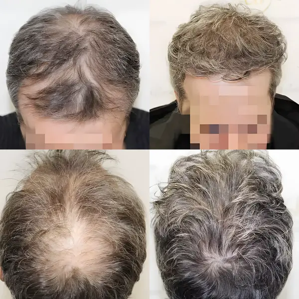 FUE crown, mid-scalp & frontal — 3,595 grafts / 7,550 hairs