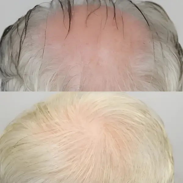FUE crown transplant — 1,611 grafts / 3,916 hairs