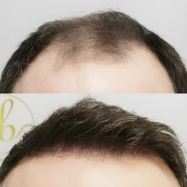 FUE hairline & mid-scalp — 4,146 grafts / 11,044 hairs