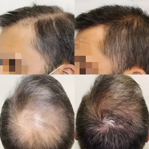 FUE crown & parting — 2,500 grafts
