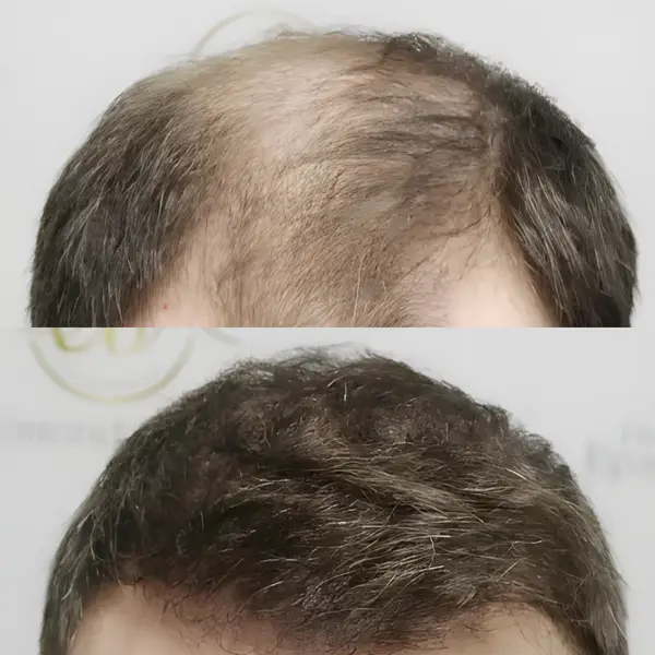 FUE hairline & mid-scalp — 4,146 grafts / 11,044 hairs