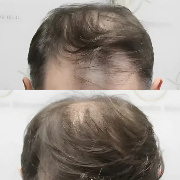 FUE hairline transplant — 2,122 grafts / 5,675 hairs