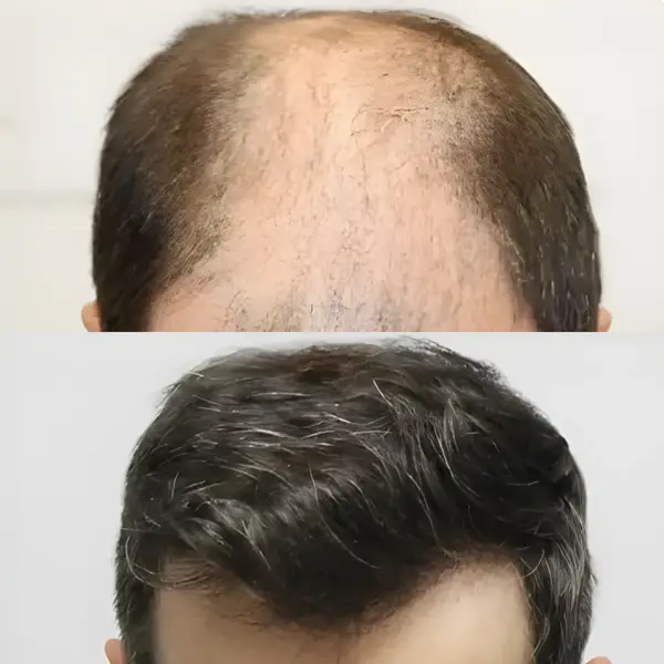 FUE hair transplant — 4,033 grafts / 8,024 hairs