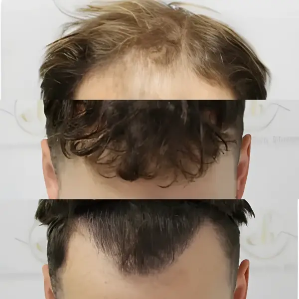 FUE receding hairline — 2,003 grafts / 4,390 hairs