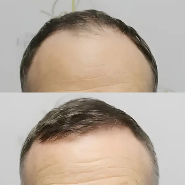 FUE front & mid-scalp rejuvenation — Dr Bonaros
