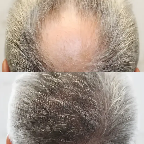 FUE crown transplant — 1,858 grafts / 4,335 hairs