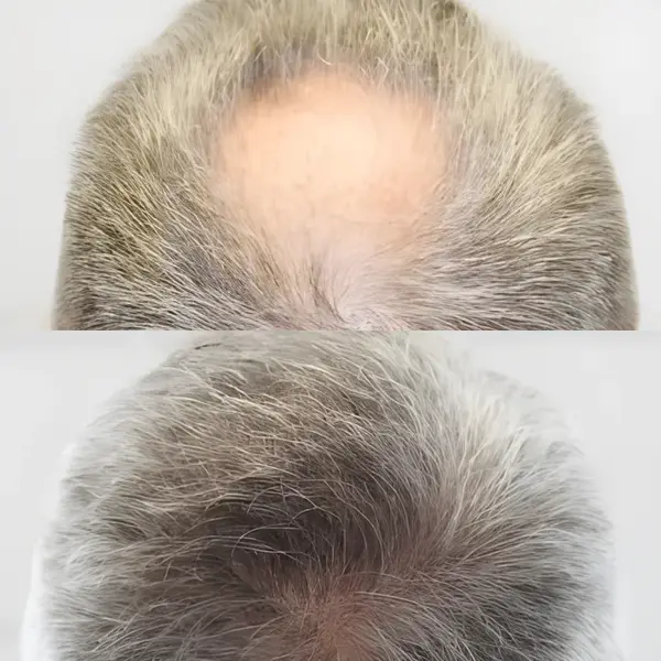 FUE crown transplant — 1,858 grafts / 4,335 hairs