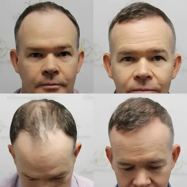 FUE receding hairline — 1,990 grafts / 3,893 hairs