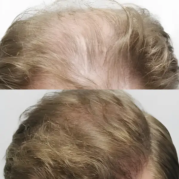 FUE hairline, mid-scalp & crown — 4,081 grafts / 8,253 hairs