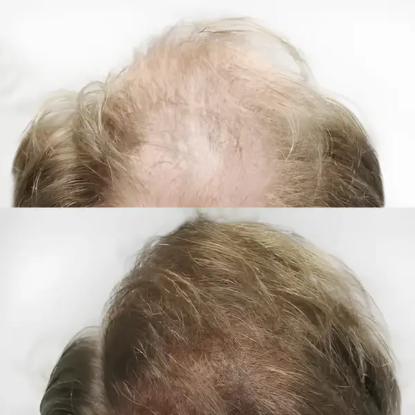 FUE hairline & crown restoration — Dr Bonaros