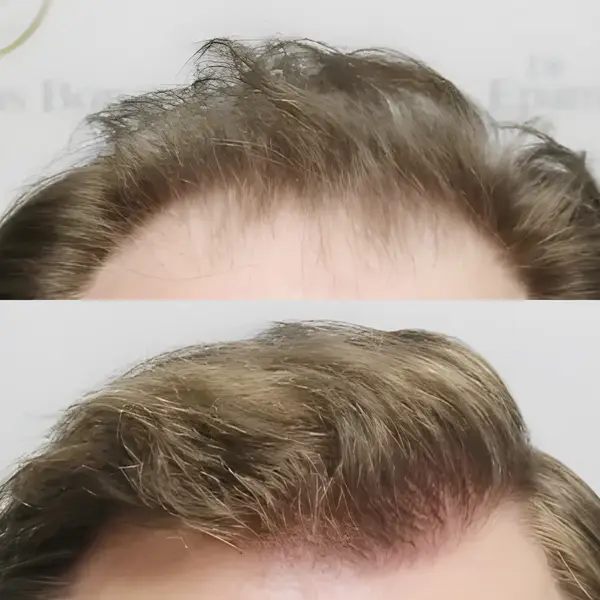FUE hairline, mid-scalp & crown — 4,081 grafts / 8,253 hairs