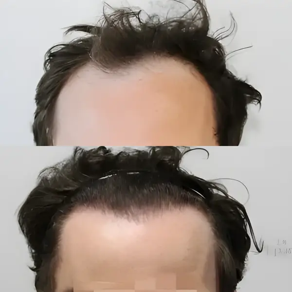 FUE receding hairline — 2,003 grafts / 3,939 hairs