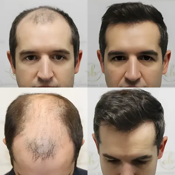 FUE hair transplant — 4,033 grafts / 8,024 hairs