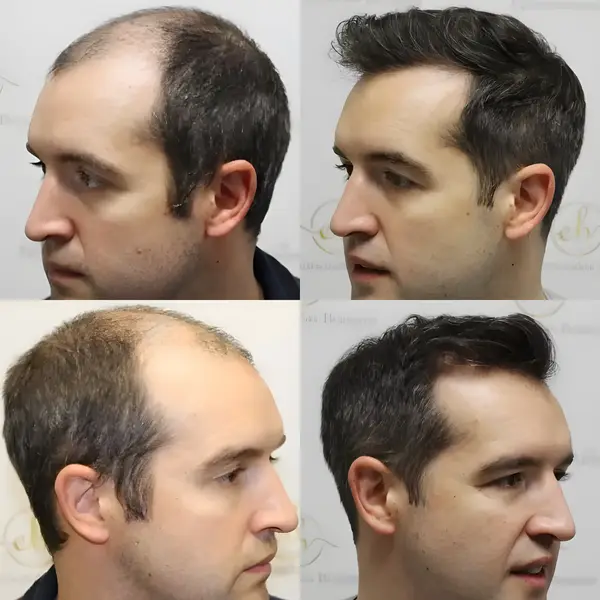 FUE hair transplant — 4,033 grafts / 8,024 hairs
