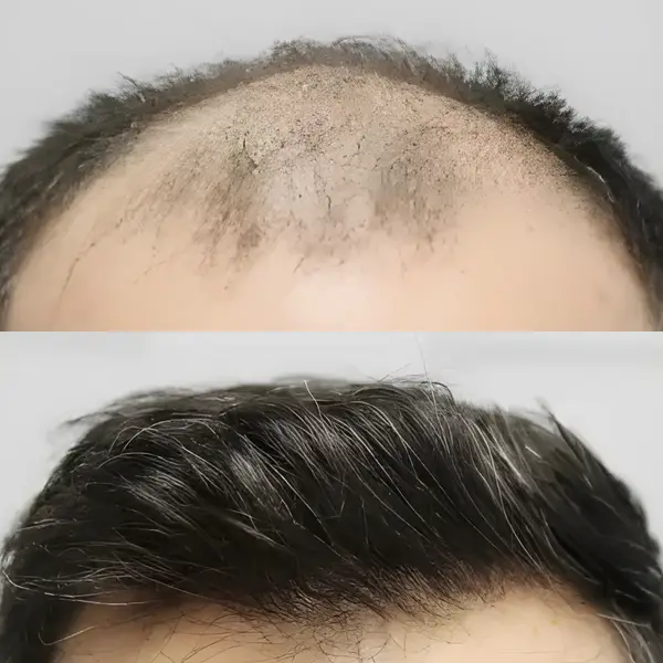 FUE hair transplant — 4,033 grafts / 8,024 hairs