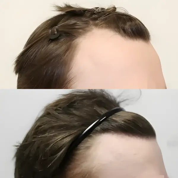 FUE receding hairline — 1,614 grafts / 3,577 hairs