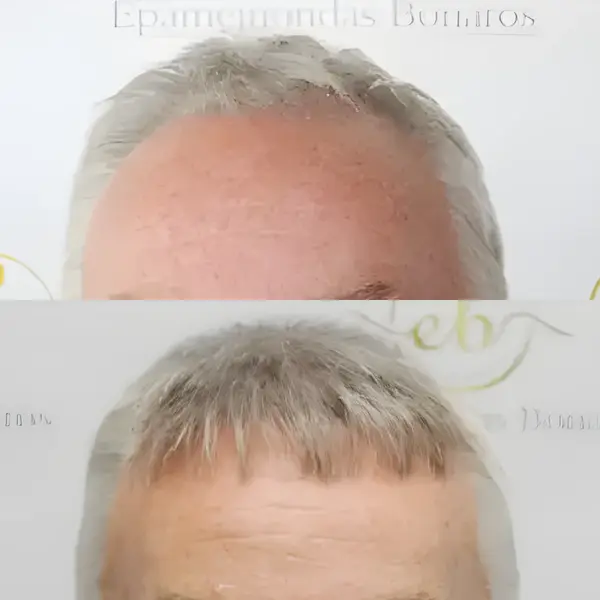 FUE full restoration, Norwood 6 — Dr Bonaros