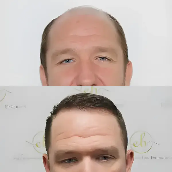 FUE hairline & crown restoration — Dr Bonaros