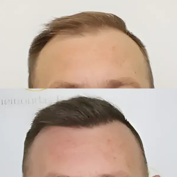 FUE hairline restoration — Dr Bonaros