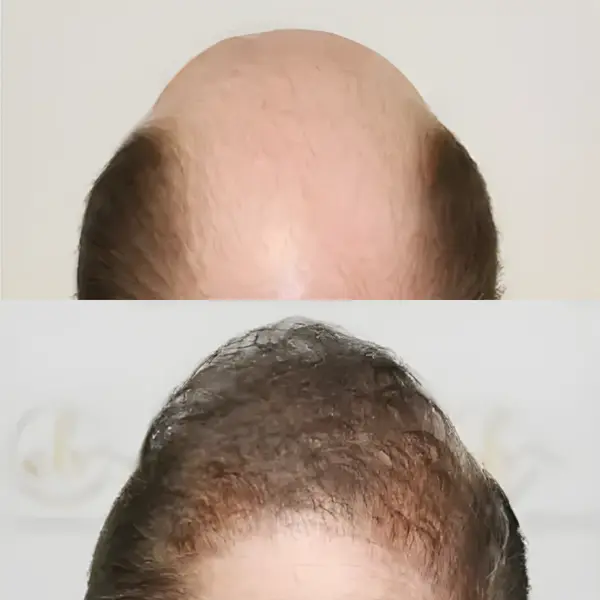 FUE crown coverage & density — Dr Bonaros