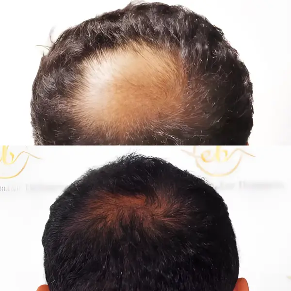 FUE crown transplant — 2,000 grafts