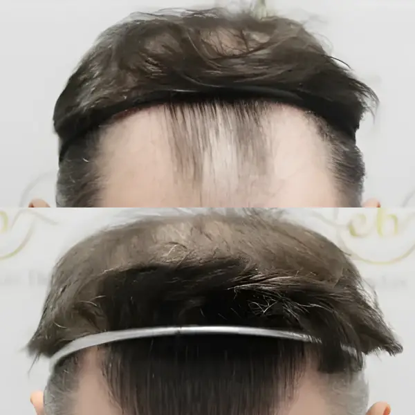 FUE hairline transplant — 2,122 grafts / 5,675 hairs