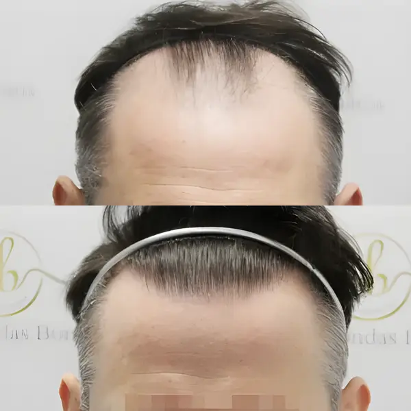 FUE hairline transplant — 2,122 grafts / 5,675 hairs