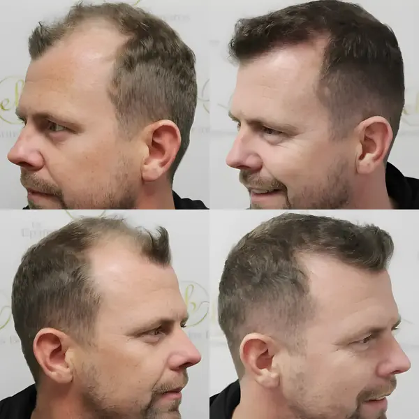 FUE hairline & mid-scalp — 4,049 grafts / 12,260 hairs