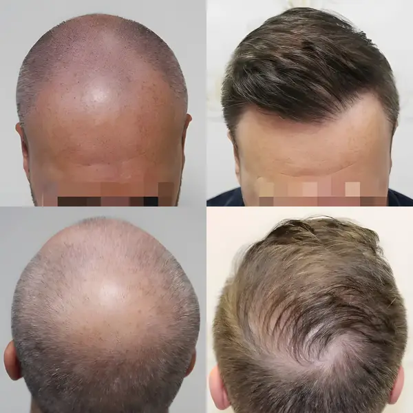 FUE receding hairline & crown — 4,076 grafts / 7,573 hairs