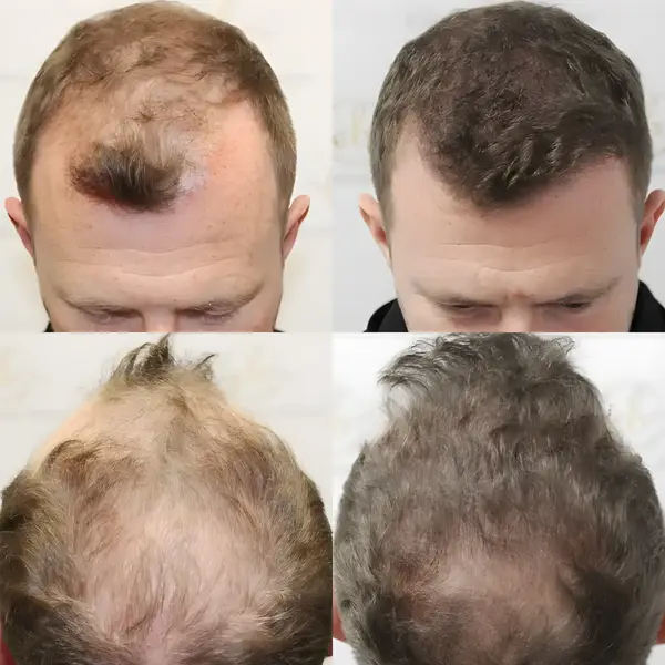 FUE hairline & mid-scalp — 4,049 grafts / 12,260 hairs