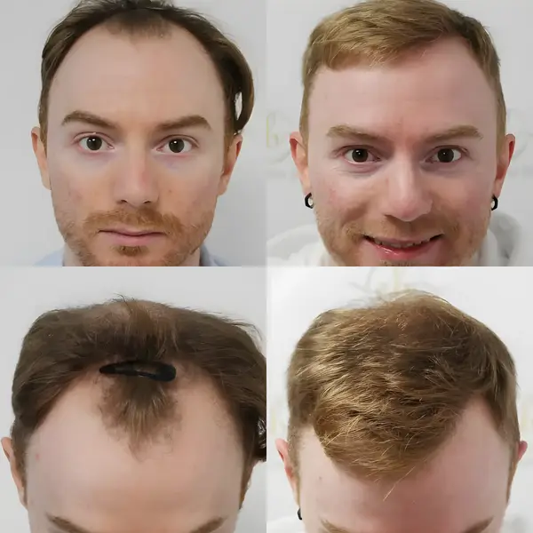 FUE hairline & crown — 3,641 grafts / 7,640 hairs