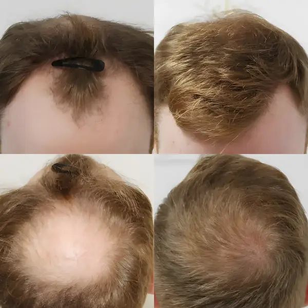 FUE hairline & crown — 3,641 grafts / 7,640 hairs