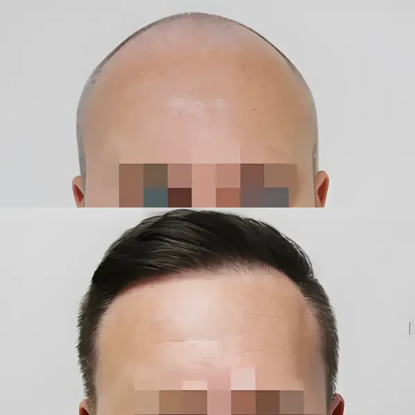 FUE receding hairline & crown — 4,076 grafts / 7,573 hairs