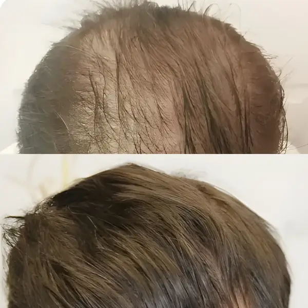 FUE mid-scalp transplant — 1,979 grafts / 4,272 hairs