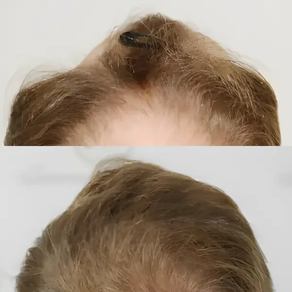 FUE hairline & crown — 3,641 grafts / 7,640 hairs