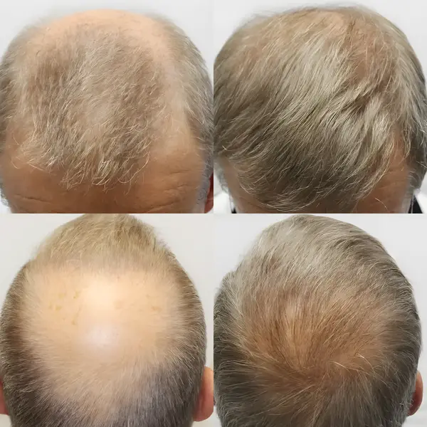 FUE hairline, crown & lateral humps — 3,102 grafts / 5,635 hairs