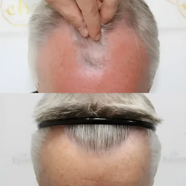 FUE hairline & crown — 3,413 grafts / 7,515 hairs