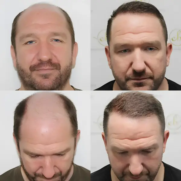 FUE hairline & mid-scalp — 3,796 grafts / 8,241 hairs