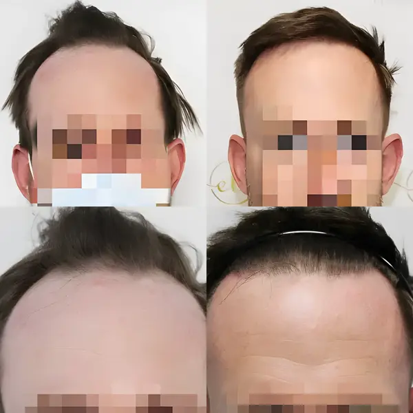 FUE hairline transplant — 1,854 grafts / 3,763 hairs