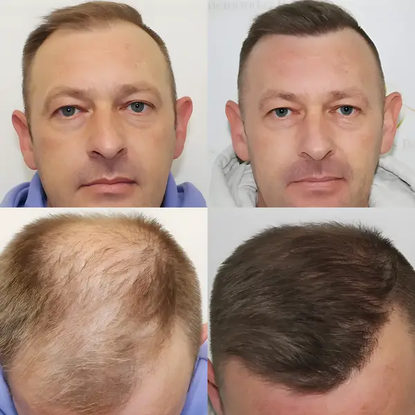 FUE receding hairline — 1,814 grafts / 4,752 hairs