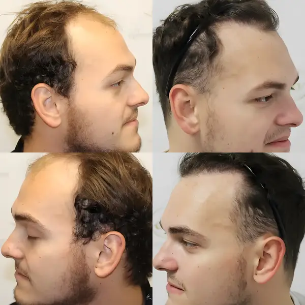 FUE receding hairline — 2,003 grafts / 4,390 hairs