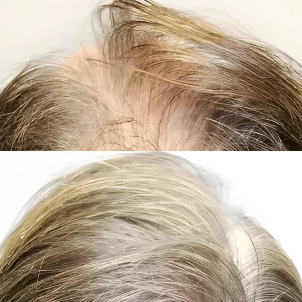 FUE hairline & crown — 3,207 grafts / 6,763 hairs