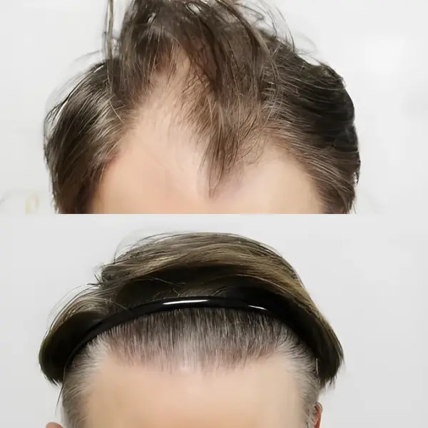 FUE hairline & crown — 3,207 grafts / 6,763 hairs
